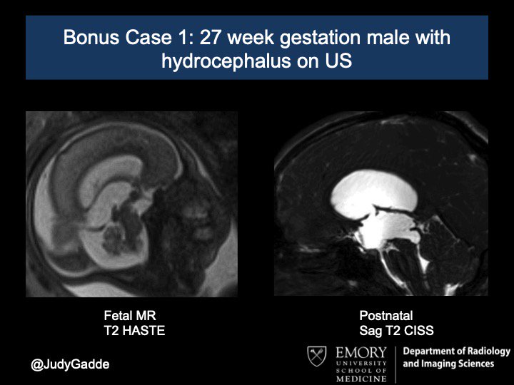 JudyGadde's tweet photo. *NEW: Emory Peds Neuro Bonus Case #1
History: 27 week gestation male with hydrocephalus
ABSOLUTELY NO GIF replies. No exceptions.
Poll open 24 hours.
#FOAMRad #FOAMed #EmoryPedsNeuro https://t.co/Yrsg4s40Zm
