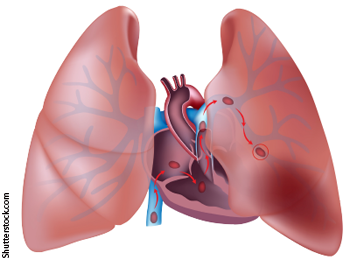 umanamd's tweet photo. What’s on today’s @ACEPNow?
A Rational Approach to Pulmonary Embolism Evaluation by @EMCases
https://t.co/1aN8dnXsoQ
#FOAMed https://t.co/ZdVBQbAQWv