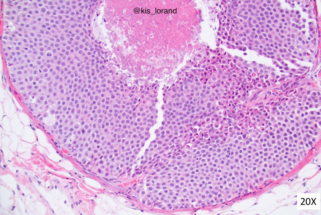 kis_lorand's tweet photo. Breast vacuum core biopsy with this sole lesion. Any thoughts on the diagnosis? What is the clinical implication of the diagnosis?
#pathology #IHCpath #breastpath https://t.co/v7yffCTMbO