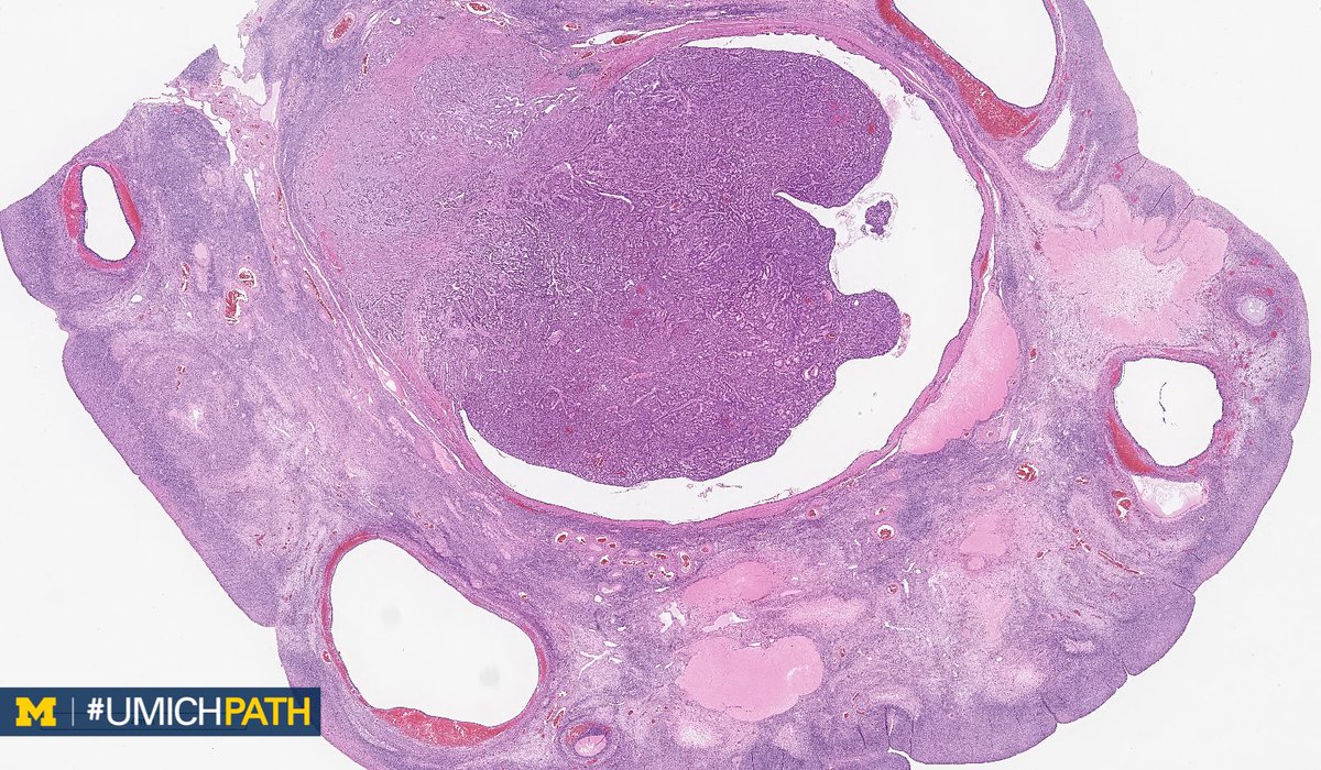 Michigan Pathology tweet media