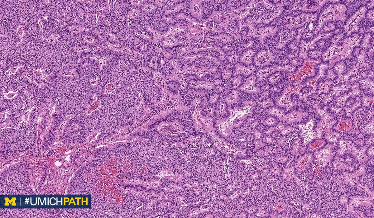Michigan Pathology tweet media