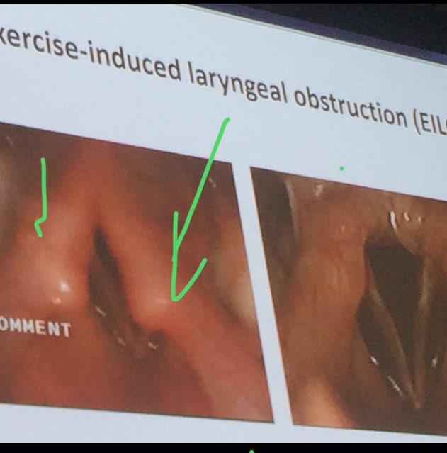 BJSM_BMJ's tweet image. Green arrows and my tremor on the larynx in EILO. #wheeze #AMSSM. Prof James Hull. Tweets as ⁦@Breathe_to_win⁩ #AMSSM19