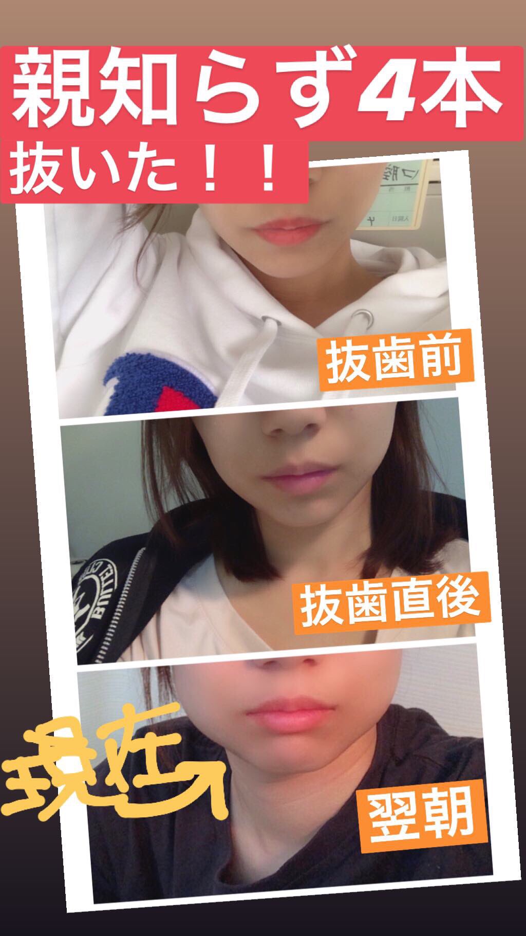 榮森みゆき 先週は親知らず4本同時に抜歯 全身麻酔の為人生初めての入院生活だった 腫れは覚悟してたけど想像以上でインスタにこれ載せたらdm沢山貰った 普通のご飯食べられるようになったら焼肉食べたい 絶対いく 焼肉