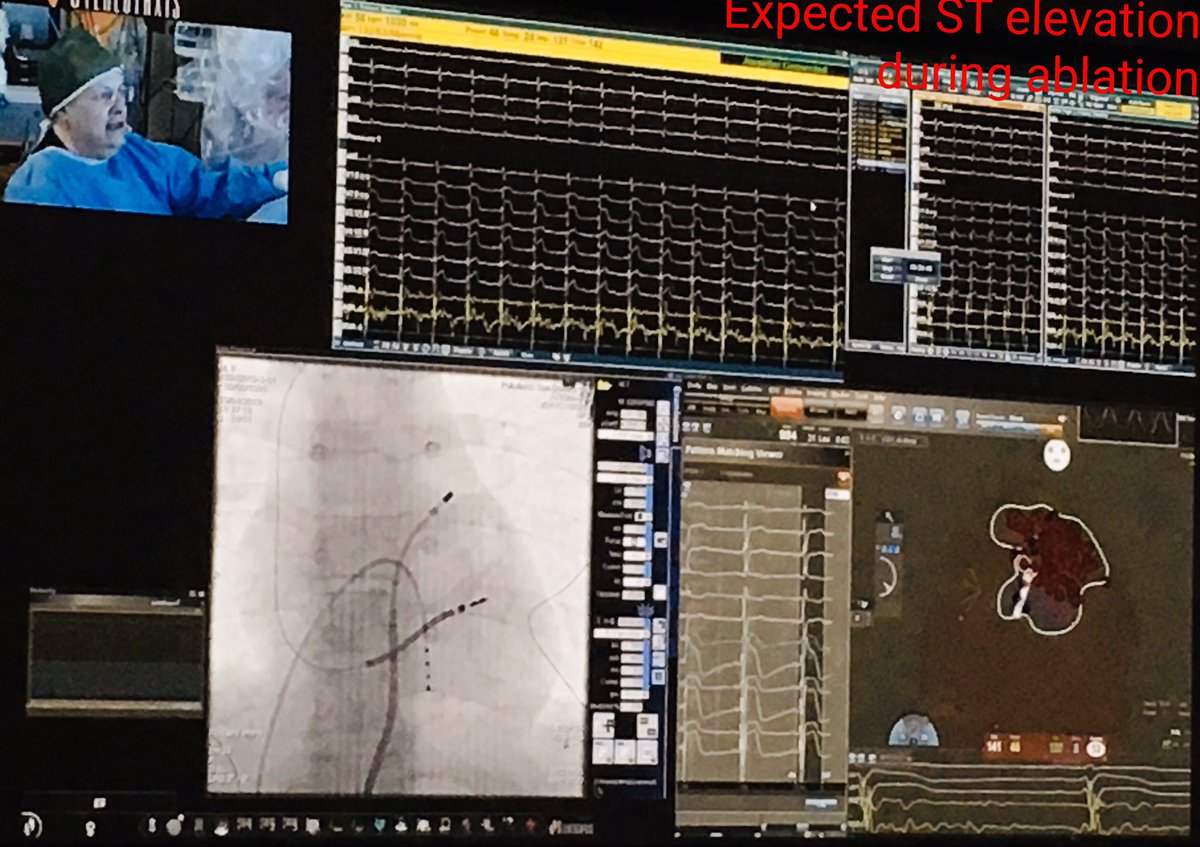 New ablation strategy for Brugada Syndrome proposed by @cpappone and @GiuseppeCiconte live from Milan at #PragueAblationWorkshop #BrugadaSyndrome #ShallowAblation @josep_brugada @Pedrobrugada #EPeeps