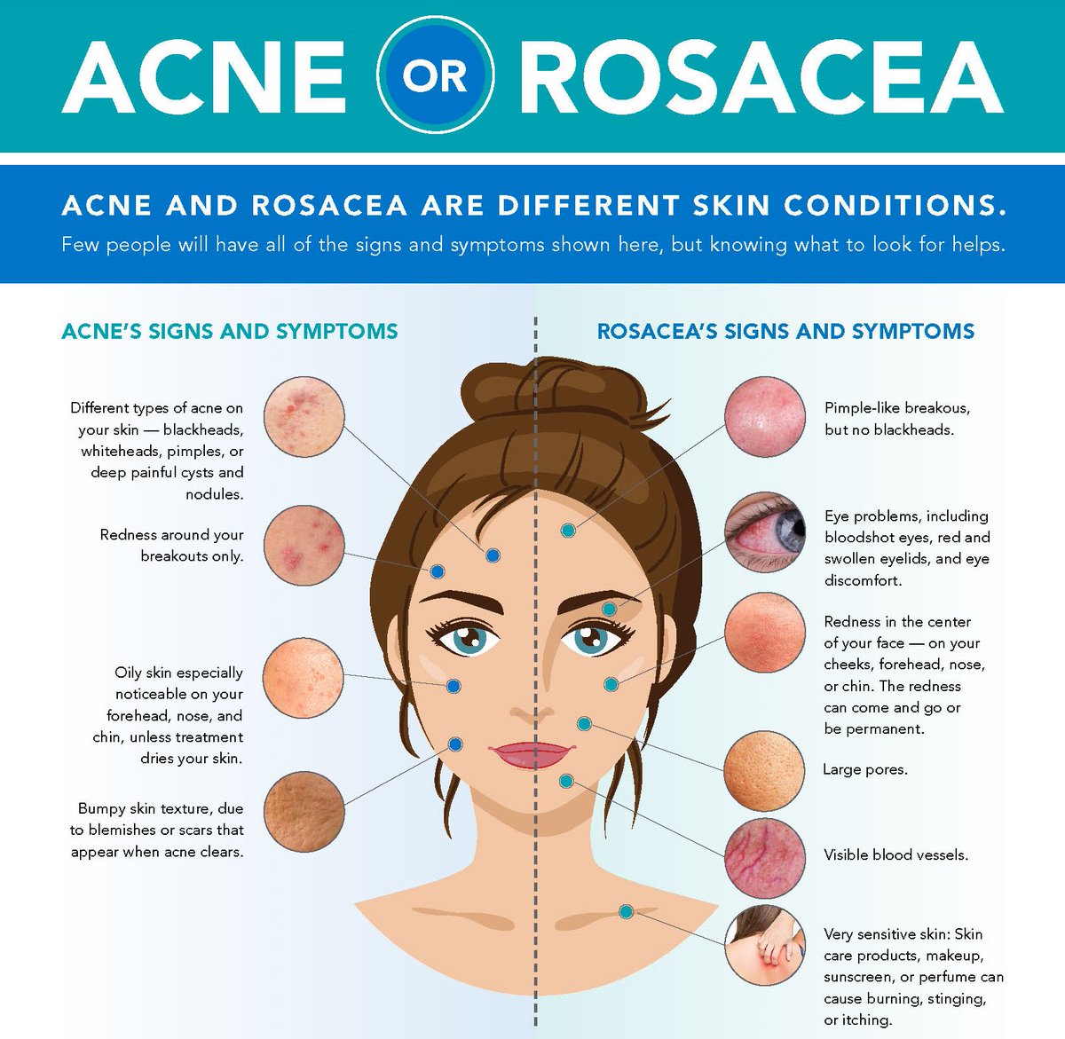 AADskin's tweet photo. Is that #acne or #rosacea? Learn the difference between these two conditions that can both cause redness:  https://t.co/sHdEZjohhW #RosaceaAwarenessMonth https://t.co/77MNOGt5hb