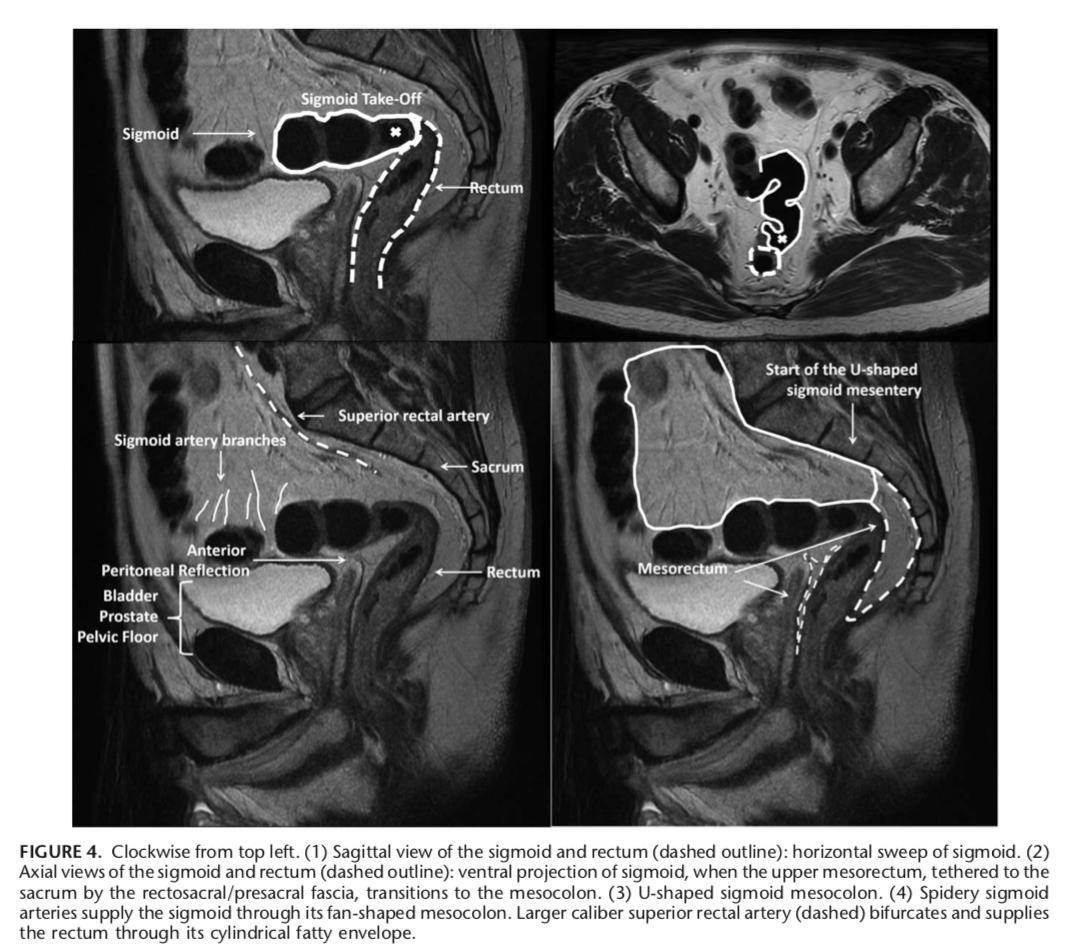 Debby Keller, MD (@debby_keller) on Twitter photo Definition of the Rectum: An International, Expert-based Delphi Consensus
<a href="/AnnalsofSurgery/">Annals of Surgery</a> <a href="/therealnige/">nigel</a> <a href="/AntoniodeLacy/">Antonio de Lacy</a> <a href="/prof_gina_brown/">Colorectal Cancer</a> <a href="/R_Perez_MD/">Rodrigo O Perez</a> <a href="/DrGarciaAguilar/">Julio Garcia Aguilar</a> <a href="/SWexner/">Steven D Wexner MD, PhD</a>
#colorectalsurgery #colorectalresearch
insights.ovid.com/crossref?an=00… Definition of the Rectum: An International, Expert-based Delphi Consensus
<a href="/AnnalsofSurgery/">Annals of Surgery</a> <a href="/therealnige/">nigel</a> <a href="/AntoniodeLacy/">Antonio de Lacy</a> <a href="/prof_gina_brown/">Colorectal Cancer</a> <a href="/R_Perez_MD/">Rodrigo O Perez</a> <a href="/DrGarciaAguilar/">Julio Garcia Aguilar</a> <a href="/SWexner/">Steven D Wexner MD, PhD</a>
#colorectalsurgery #colorectalresearch
insights.ovid.com/crossref?an=00…