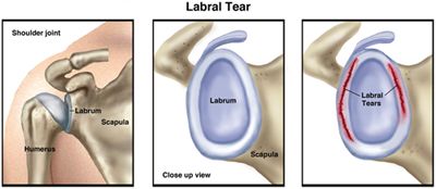 LincolnPTSR's tweet photo. LABRAL TEAR OF THE SHOULDER | the term "labral" refers to the ring of cartilage that is within the shoulder joint. If this cartilage is torn or frayed, you may experience shoulder pain, instability or even frequent dislocations of the shoulder joint. https://t.co/u1EGLAmdjb