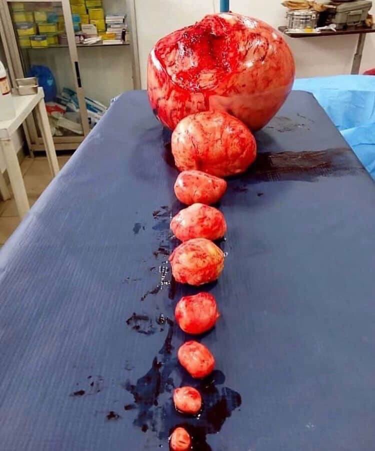 JackiePhamotse's tweet photo. Dear Men - These are fibroids- if you have a woman in your life who suffers from severe periods and is experiencing depression she probably has these demons growing in her or she has some other reproductive health issues that are wreaking havoc on her hormones...... https://t.co/N0f6NYdHuO