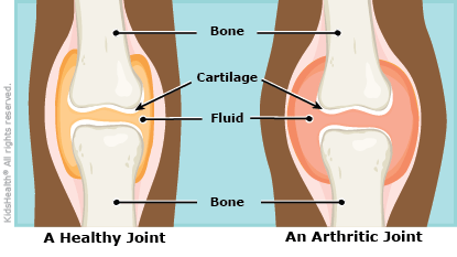 On Friday you got to see an example of JA in the knee from the outside perspective. Today, the diagram below depicts what the inside of the knee looks like in someone who has JA.