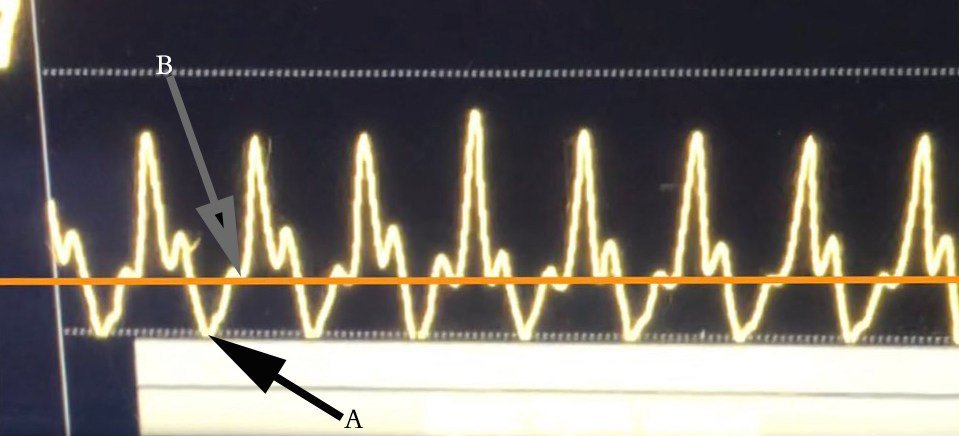 emcrit's tweet image. One of the most important podcasts I have ever done: EMCrit Podcast 244 - We have been using the wrong pressure for DBP vasopressor titration in Cardiac Arrest with @sonorambler emcrit.org/emcrit/dbp-cpr/