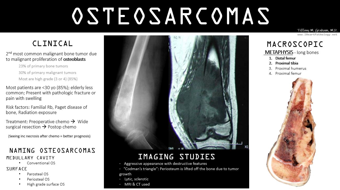 Osteogenic Codmans Triangle