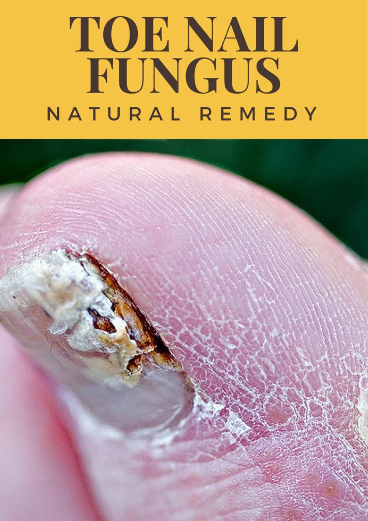 #Natural Nail #Fungus Treatment - healing-oils.info/natural-nail-f…