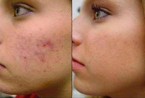 Biancab787's tweet photo. Você profissional da saúde, já está na hora de investir em um tratamento 100℅ Natural, o Peeling Rose De Mer, já ouviram falar? Convido a todos as profissionais pelo menos para saber como funciona e o baixo custo que é!!
Link para + informações
https://t.co/2oIsEHmVeW https://t.co/F3msjgNNMJ