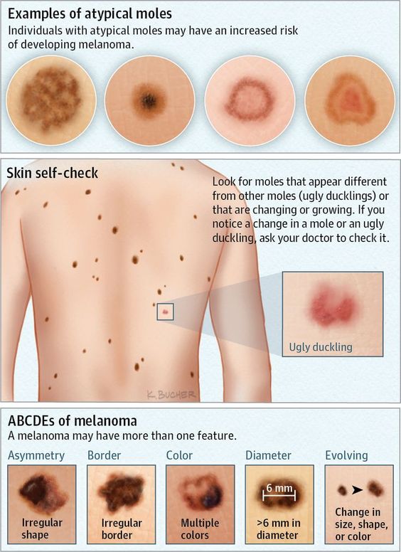 polkadotmamainc's tweet photo. Check your spots!  Or have one of our 30+ volunteer dermatologists do it at the Guinness Book event May 18.  Share this post and sign up here https://t.co/rMHntB6cEY for a time slot.  It is FREE!  #polkadotmama #skinscreening #melanoma #guinness https://t.co/i1alcKH8rQ