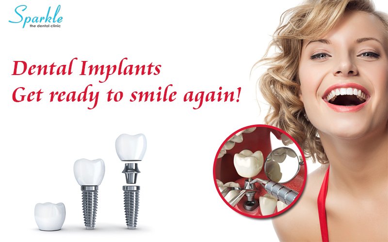 Not just your body, now your teeth can also be in shape! How? Dental implants from Sparkle is the answer. So, visit us for the best dental implant solutions. #Appointment -9730987134 Visit:- sparkledentalclinic.com  #dentists  #dental #inmanaligner #kalyaninagar