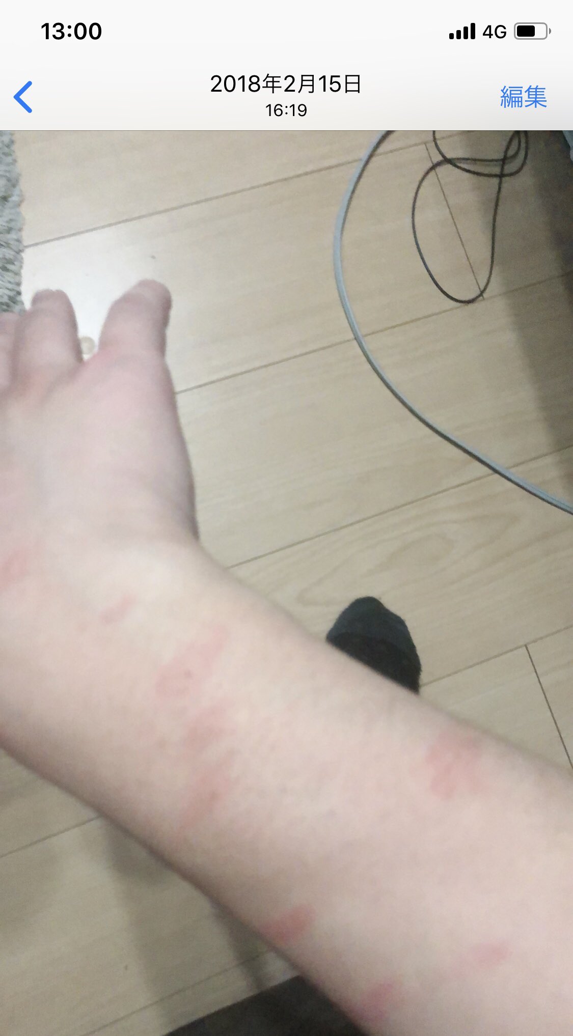 しまこ 友達の歌い手さん家の猫にひっかかれた跡だよ笑 猫アレルギーな私はそのあと腕が酷いことになってました T Co Jz7l6rpqvm Twitter
