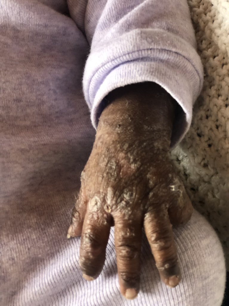 iamSivN's tweet image. I met this little princess this weekend , she was left in the bushes by her “mother” and she was eaten by insects/animals! But she smiles and laughs  nonstop, she stole my heart!