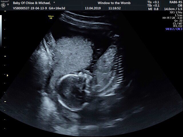 Chloe_27x's tweet photo. Missing playing football baaadly but if I’m stopping for any reason, this one is worth it 💕🌸🍼 Gutted to be missing a semi final and hopefully a final with my team but il be back 💪🏽⚽️ #WeAreBromley https://t.co/pFofkxKPJ5
