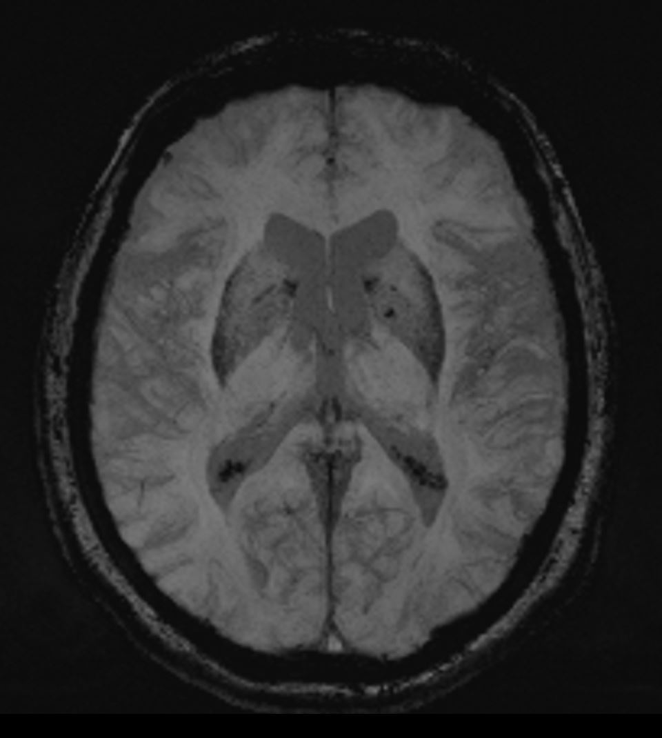 VictorSuarez_Rx's tweet photo. #SWI nicely depicts "venograms" due to the susceptibility of desoxygenated blood.
This 70yo patient was sedated with high-flow O2. This affected the MinIP with paucity of venous structures.
#MRI #3Tesla #MRItips https://t.co/9w1O59c8LC