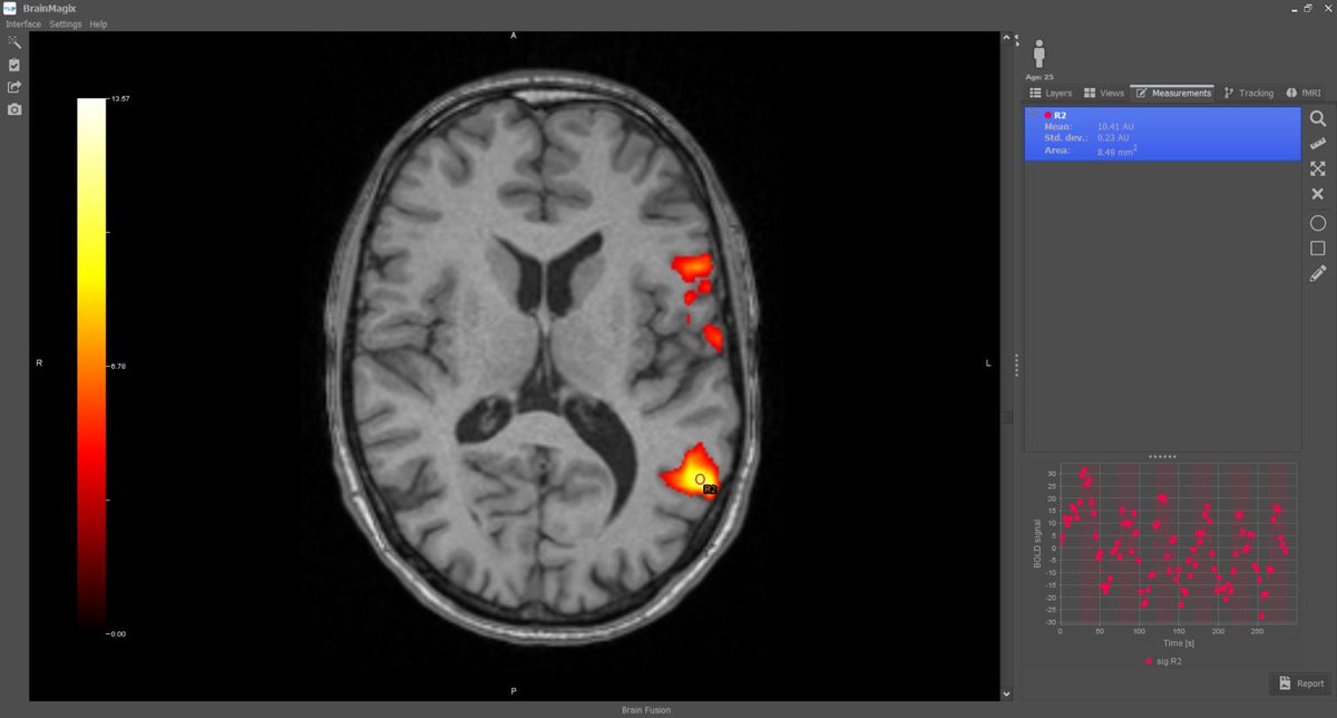Imagilys's tweet photo. #Wernicke's area (yellow) is located in the temporal lobe of the #brain. It is the area responsible for the comprehension of #language. In most people, Wernicke's area is located in the left hemisphere. The #fMRI images were post-processed in #BrainMagix. https://t.co/ZuvD5RxP1U