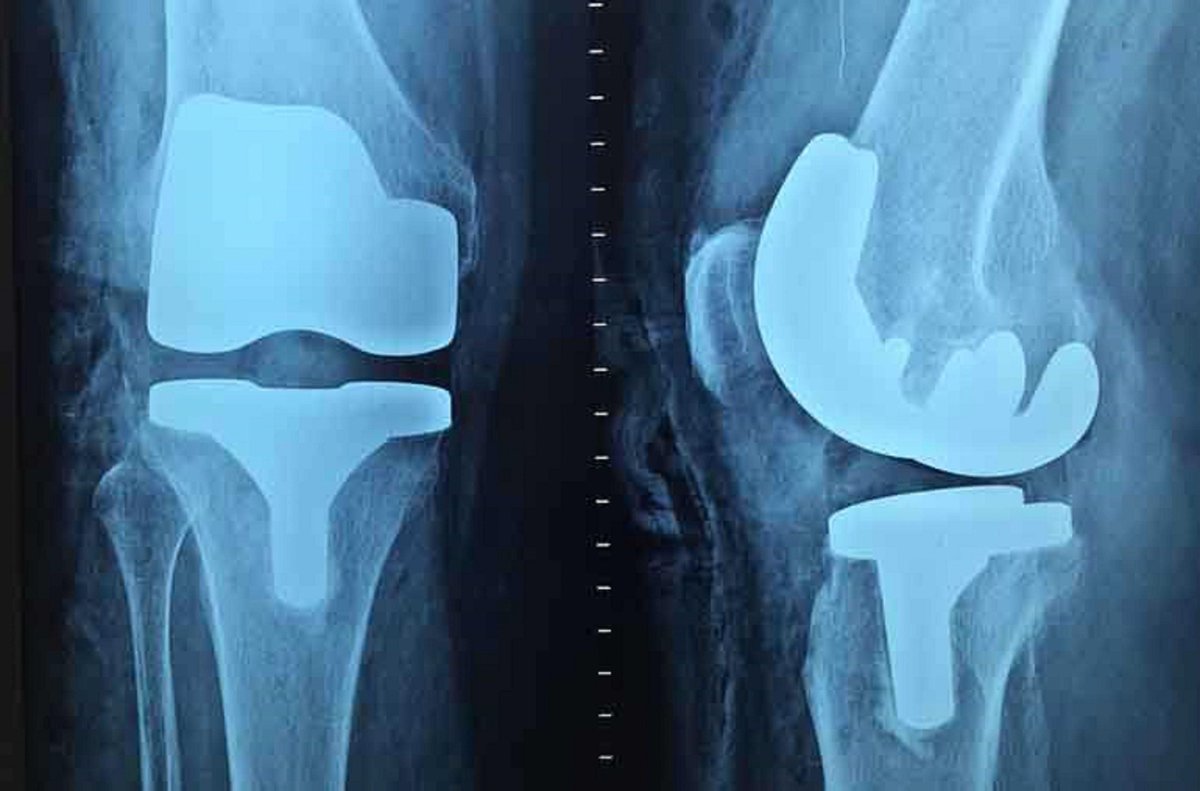 Spine2019's tweet photo. Spinal implants are used in treating disorders of the #spinal column. An increase in the incidence rate of spinal #disorders, spinal #stenosis are driving the market growth. Most of the spine implants are used to correct deformities of the spine by stabilizing and strengthening. https://t.co/28qEVuyfot