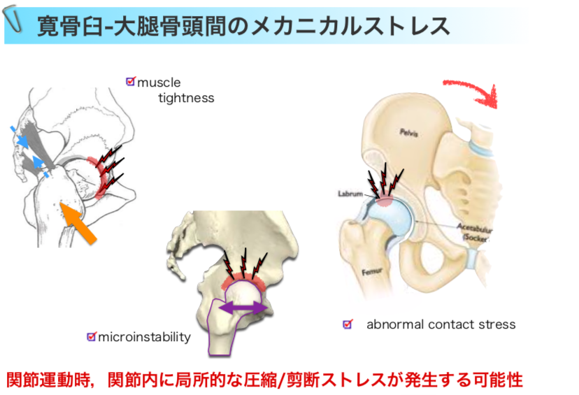 北海道の理学療法士 菅原和侑 در توییتر 股関節インピンジメント 股関節のインピンジメントには複数の原因がある 股関節に関節の不安定性がある場合も 逆に筋の短縮 緊張により関節に圧縮がかかって起こる場合もある また 骨盤の位置関係により インピンジ