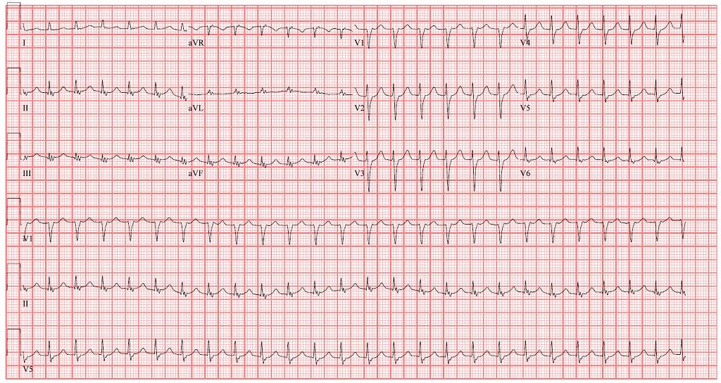 Have you tested your knowledge w/ the ECG of the Month? 
