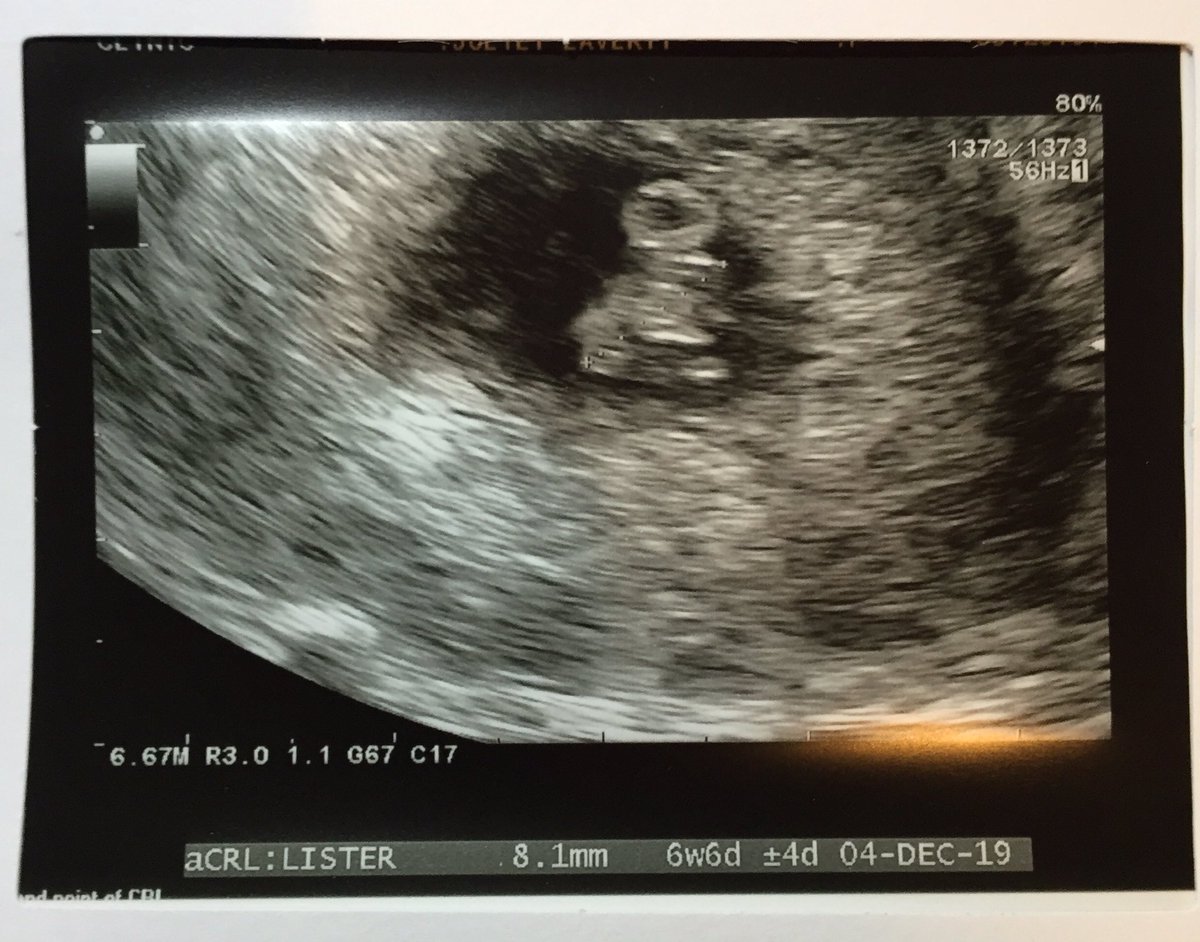tubesdontwork's tweet photo. Scan today at 6w6d and all looking good, measuring on track so ๐ค that continues #firstFET #round4 #IVF #infertility https://t.co/wIPKXitxrk