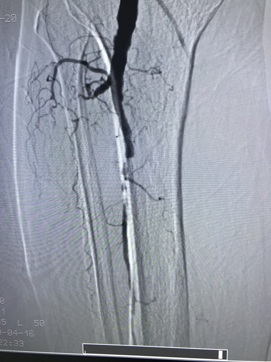 WilliamWuHVC's tweet photo. Below knee and below ankle intervention #CLIFighters.  84 yo gentleman presented with ischemic changes, non-healing heal ulcer.  Angio showed occluded PT, AT and 90% stenosis of peroneal.  Atherectomy to AT and DP w/ PTA to peroneal.
@JamilMalikSTCC @AnandPrasadMD @BruceKuoMD https://t.co/t9hNp81llo