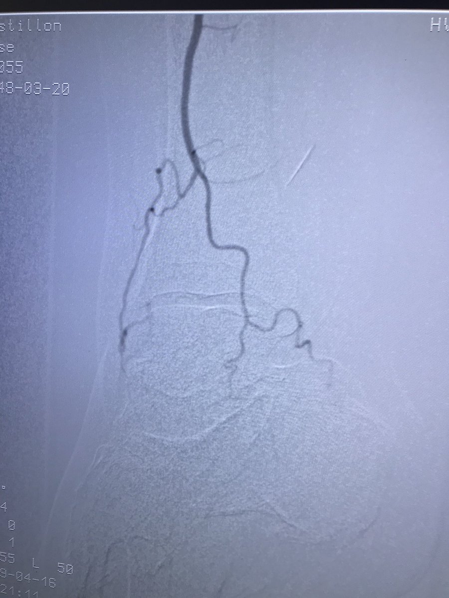 WilliamWuHVC's tweet photo. Below knee and below ankle intervention #CLIFighters.  84 yo gentleman presented with ischemic changes, non-healing heal ulcer.  Angio showed occluded PT, AT and 90% stenosis of peroneal.  Atherectomy to AT and DP w/ PTA to peroneal.
@JamilMalikSTCC @AnandPrasadMD @BruceKuoMD https://t.co/t9hNp81llo