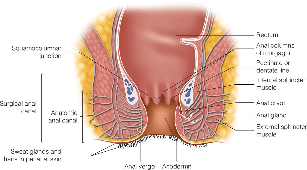 DrLuisEspino's tweet image. Diferencias anatomicas entre canal anal anatomico (hasta linea dentada) y quirurgico (hasta anillo anorectal). 
Anatomical differences between anatomical anal canal (to dentate line) and surgical (to anorectal ring).
#ColorectalSurgery
#Analcanal
#Analcancer
#Cancerdeano
#Surgery