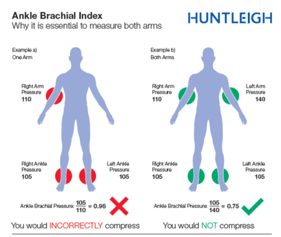 Huntleighdiag's tweet photo. A true #AccurateABI requires both arm pressures to be taken as stated in International Guidelines. Talk to the #ABI experts on stand 209 at #CX2019 to find out more. #2Arms #ABPI https://t.co/Lm4GTQgffg