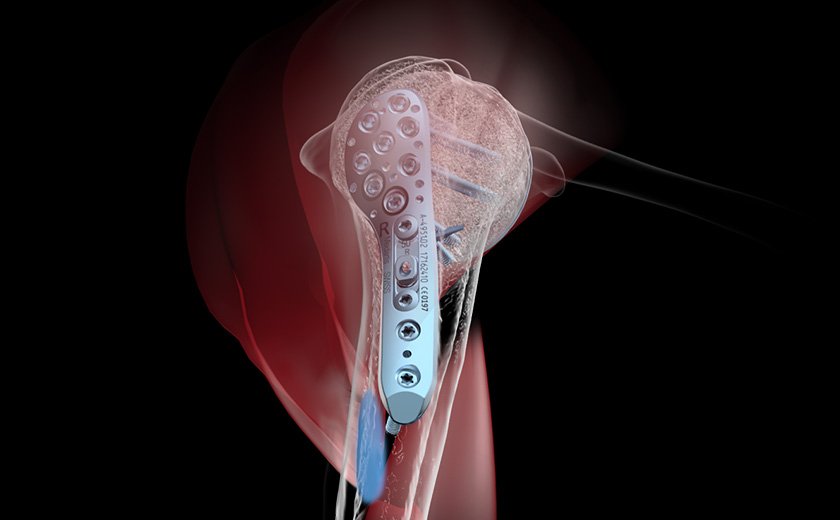 Medartis_Global's tweet photo. The 5th Munich Shoulder Fracture Course - and we will be on site! Take the possibility to try out our new APTUS 3.5 Proximal Humerus System at one of the workstations in Munich. #APTUSShoulder
Find out more: https://t.co/Rin63R4d8i https://t.co/MTlSm4MfZx