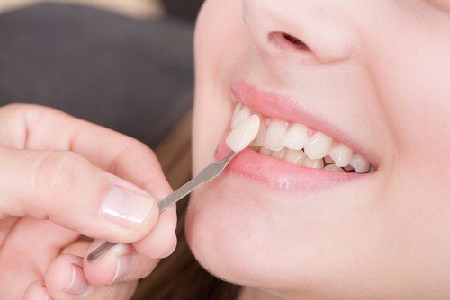TeachDental's tweet photo. Dental veneers are thin #porcelain shells that cover the front of a damaged or discolored tooth. For more information call us! #damagedtooth #discoloredtooth #dentalveneers https://t.co/4W0gZ0WmgY https://t.co/z6qg0cWSWH