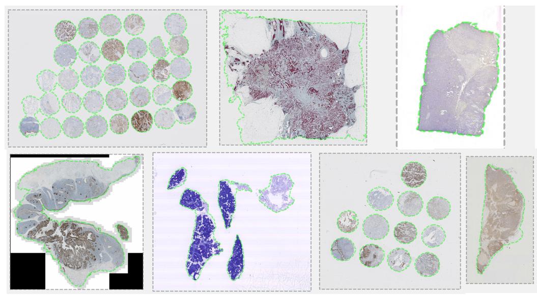 dn_mason's tweet image. Getting my teeth into #DeepLearning for #DigitalPathology this afternoon, building a general purpose tissue classifier using @Visiopharm implementN of #DeepLabV3

Genuinely impressed how little training is required to make it work on almost any tissue/stains I can throw at it!