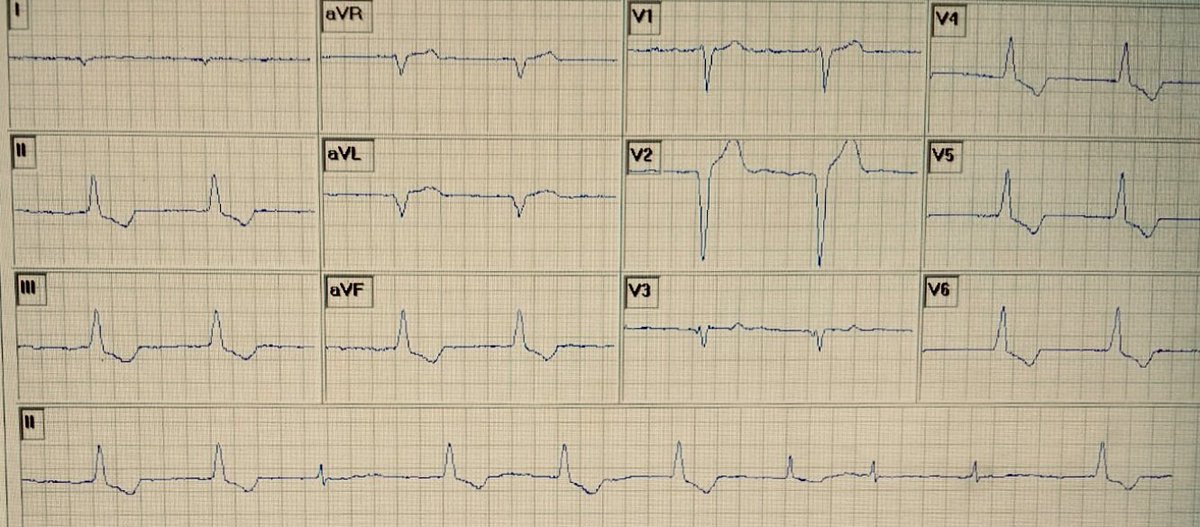 Albouaini's tweet photo. Known AF 
No other PMH known

Comments invited #CardioEd #EPeeps #ecgrhythms #CardioTwitter #cardiology https://t.co/XTTb1CGFQf