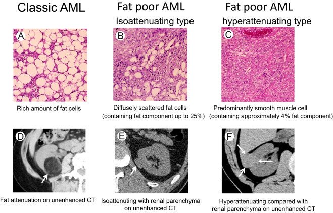 UltrasoundBySai's tweet photo. DIAGNΓSTICO DE ANGIMIOLIPOMAS RENALES
https://t.co/V1d9NVP5T2
#renal #tumor #Ultrasound #ctisus #MRI #abdomen
#Diagnostic https://t.co/e9gYvG5Jhb