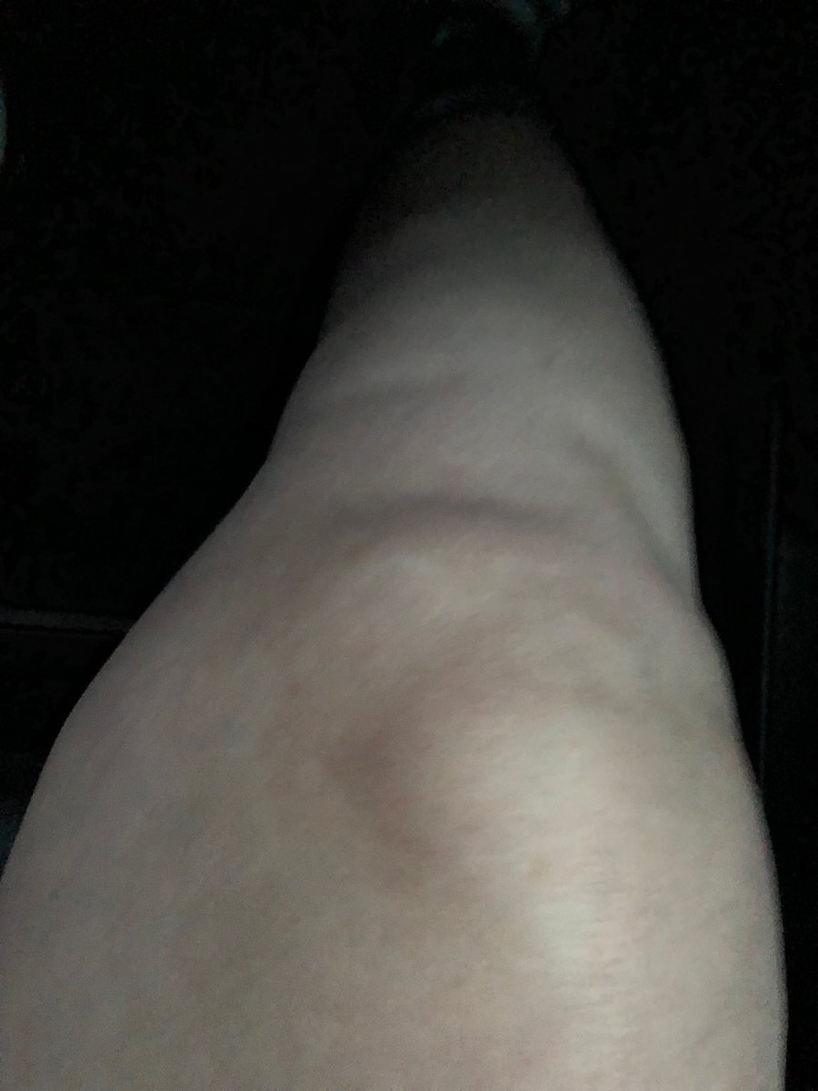 KathleenGalarza's tweet photo. Pre-op #knee 6:30am & post-op knee 12:30pm today. #knee #replacement Thank You. 👍🤗🤗🤗🤗👍😘@RothmanOrtho #DrOng https://t.co/cLnH5zKp2q