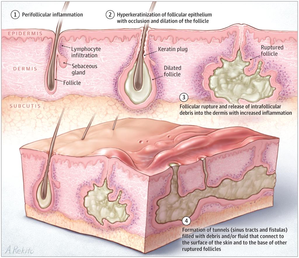 Jama Dermatology On Twitter The Overall Comorbidity Burden In Patients With Hidradenitis Suppurativa Has Implications For Mortality Risk And Resource Use And It May Warrant Multidisciplinary Implementation Of Routine Screening Measures Https T Co