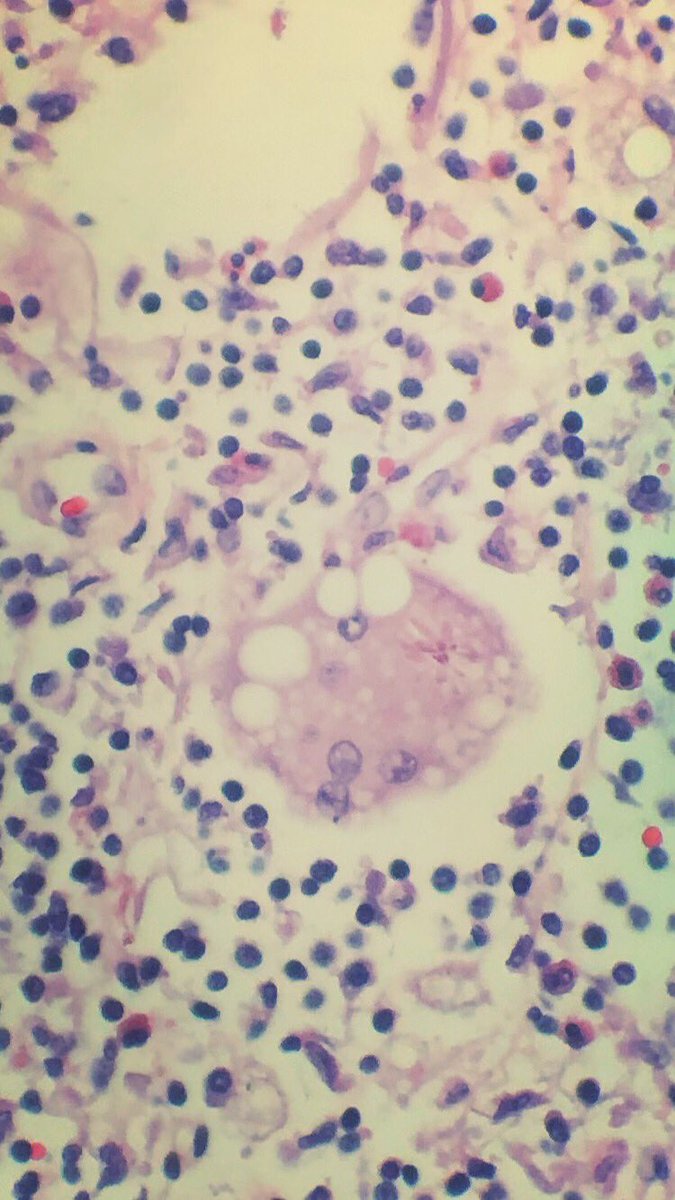 Ania_Henning_MD's tweet photo. Granulomatous inflammation in a lymph node #pathology #asteroidbody https://t.co/5Z07dhEXG4