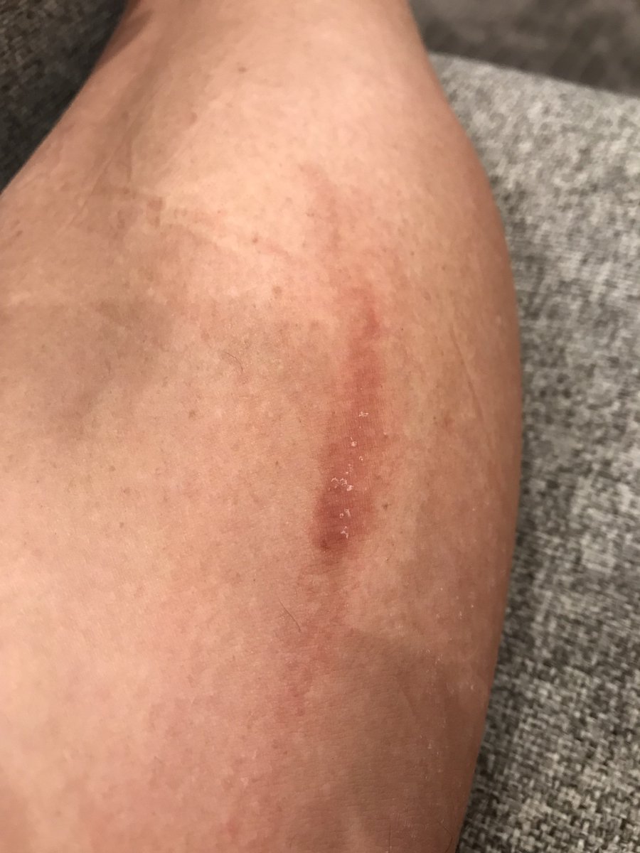 allisonpyemd's tweet photo. What is your diagnosis? 33 YO pregnant woman with linear pigmented streaks on left leg and left hand. Ask and you shall receive more history. #dermatology #skinteresting https://t.co/i1ahjcldmX