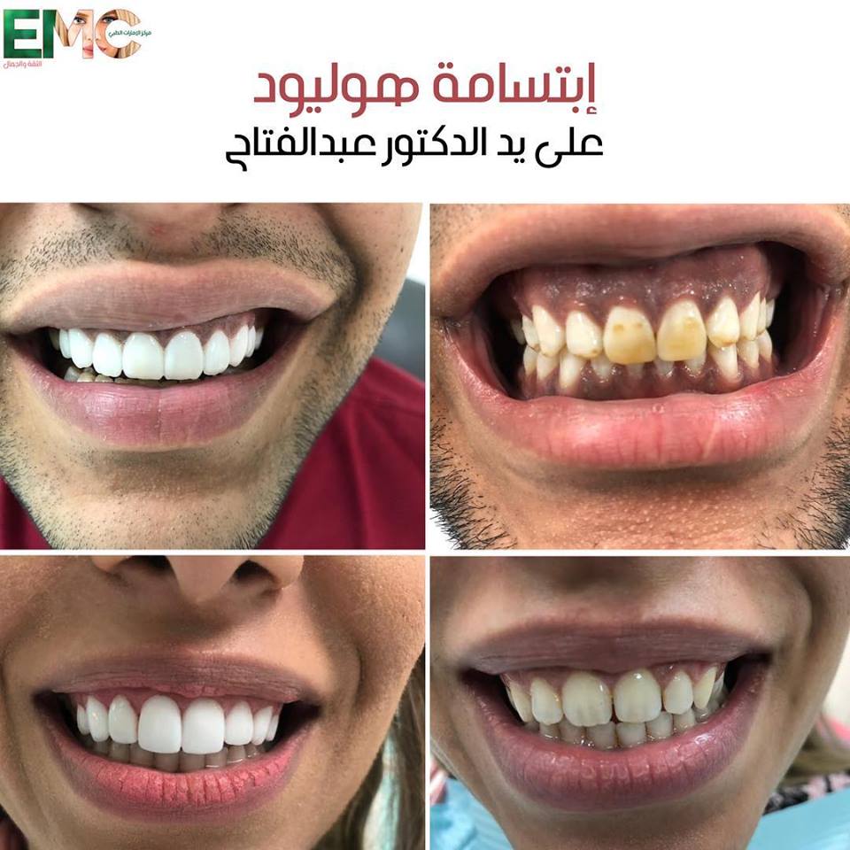 emc_oman's tweet photo. دكتور عبدالفتاح من أمهر أطباء تجميل الأسنان في فرع الصاروج بخبرة أكثر من ٢٢ سنة.
لا تفوتوا عروضنا الحصرية 
تنظيف و تلميع الأسنان مجانا عند اجراء تبيض الأسنان المنزلي او توريد مع خصم 20% .
استشارة مجانية مع طبيب تقويم الأسنان لنهاية الشهر.
للحجز : 24604540
MOH:150/2019 https://t.co/EaEDwvLS5w