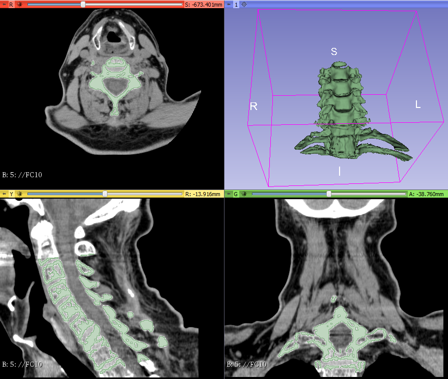 3d_maranon's tweet photo. 3D model of a spine from C3 to Th1 of a patient that sufferd a compression fracture in the C7 and a posterior fracture in the C6. This model allows a more accurate evaluation of the lession. #HospitalMarañon3D FabLab team: @rupermac @calvoharo_ja @diegotrap @sandrasv97 @kn_ord https://t.co/raSpxqtEyk