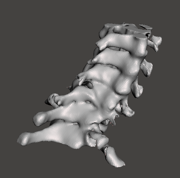3d_maranon's tweet photo. 3D model of a spine from C3 to Th1 of a patient that sufferd a compression fracture in the C7 and a posterior fracture in the C6. This model allows a more accurate evaluation of the lession. #HospitalMarañon3D FabLab team: @rupermac @calvoharo_ja @diegotrap @sandrasv97 @kn_ord https://t.co/raSpxqtEyk