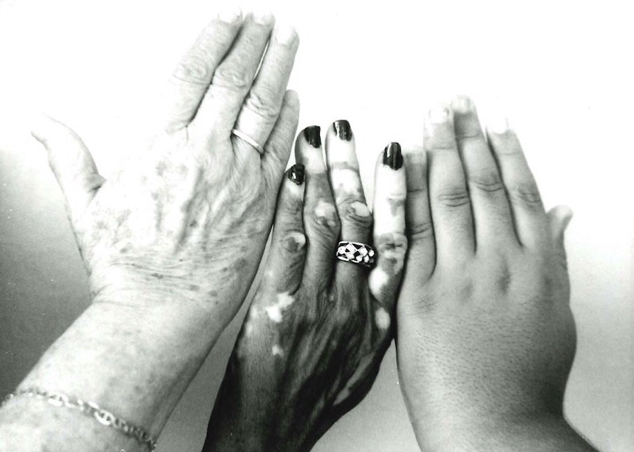 We are developing a new way to treat vitiligo by injecting DNA coding for a modified heat shock protein HSP70i to stop the autoimmune response at the outset. #vitiligo #clinicaltrials 
Photo Credit: @FotoCoqui