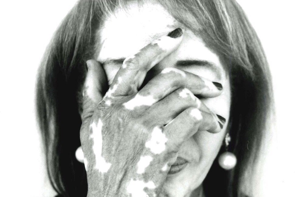 Vitiligo creates white patches that can cause people to hide their skin. It is a disease that can scar you deeply, interfering with all aspects of social and professional life. #vitiligo #TemprianTherapeutics #ClinicalTrials
Photo Credit: Andrea Lopez