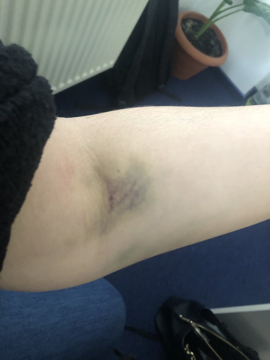 JessMSelby's tweet photo. Gotta love blood tests. Thanks to #MedCenter for this multicolored beauty and the swelling that accompanied for a solid 12 hours. And the kitchen staff for the frozen peas ✌🏽 https://t.co/90I6goe9Ov