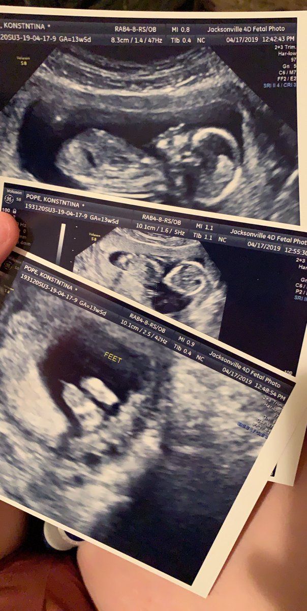 awleeex's tweet photo. ugh I’m sorry but I cannot believe my little baby is inside of me forreal, after 3 miscarriages.. I thought I couldn’t actually get pregnant and stay pregnant. Although my journey isn’t over, I’m just so happy I could cry. #8moredays https://t.co/lrPisjpa8f