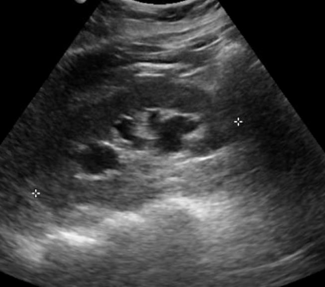 Neph_SIM's tweet photo. A throwback to Case 3 and the reasons behind #postobstructive diuresis

https://t.co/ffmtTZb0Ey

#TBT #FOAMed #MedEd #Hydronephrosis https://t.co/ZdEoYOdC8M