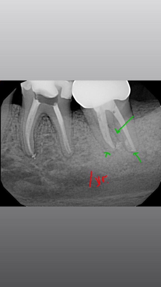 DrRicoShort's tweet photo. The SHORT Case Of The Day!
Retreatment on Tooth #18
#WorthSaving
#RelaxDontExtract https://t.co/KihJCQN1jx
